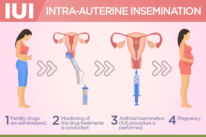 IUI Procedure